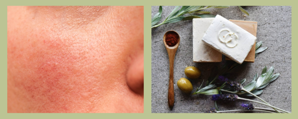 1000-X-400-Rosacea-1.png
