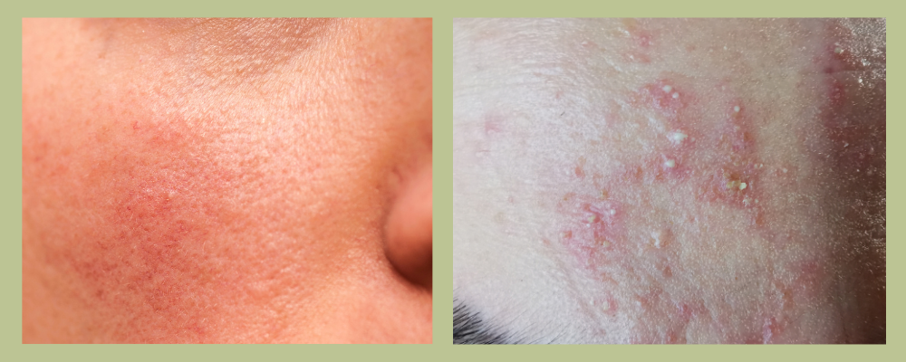 1000-X-400-Rosacea.png